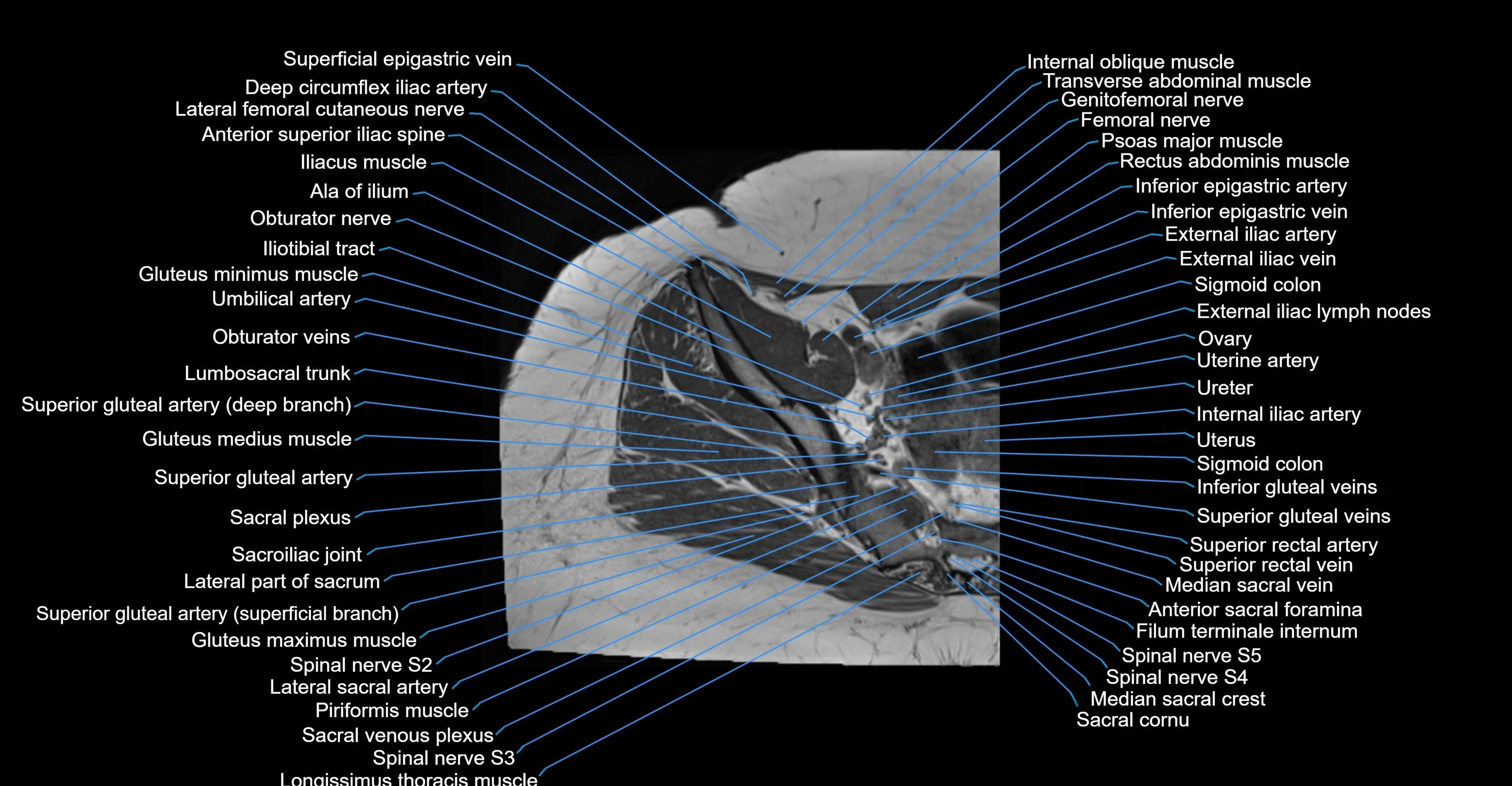 MRI hip axial cross sectional anatomy 3T 3D  radiology  anatomy image-img-00001-00007.webp